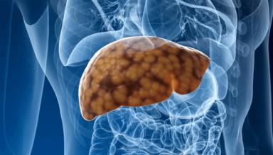 Sitio web en español ayuda a personas en riesgo de enfermedad del hígado graso